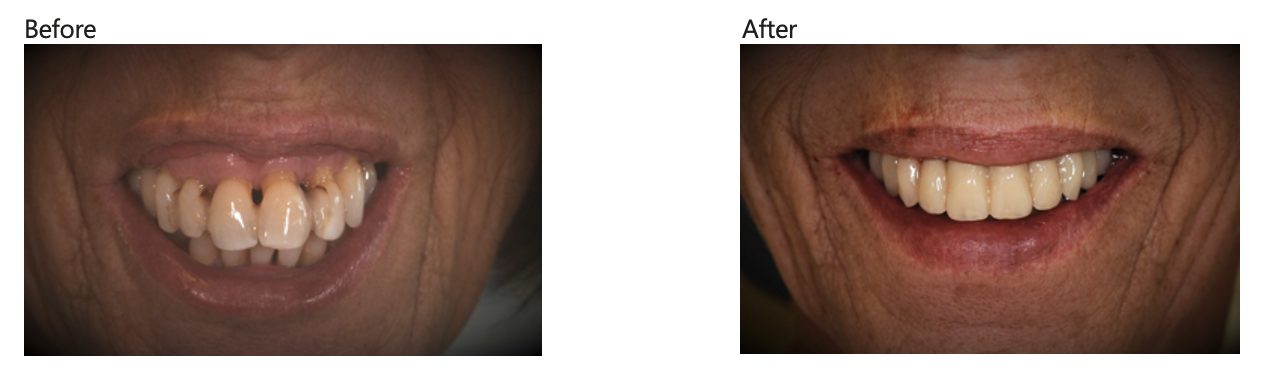 Full Arch Implants Before and After