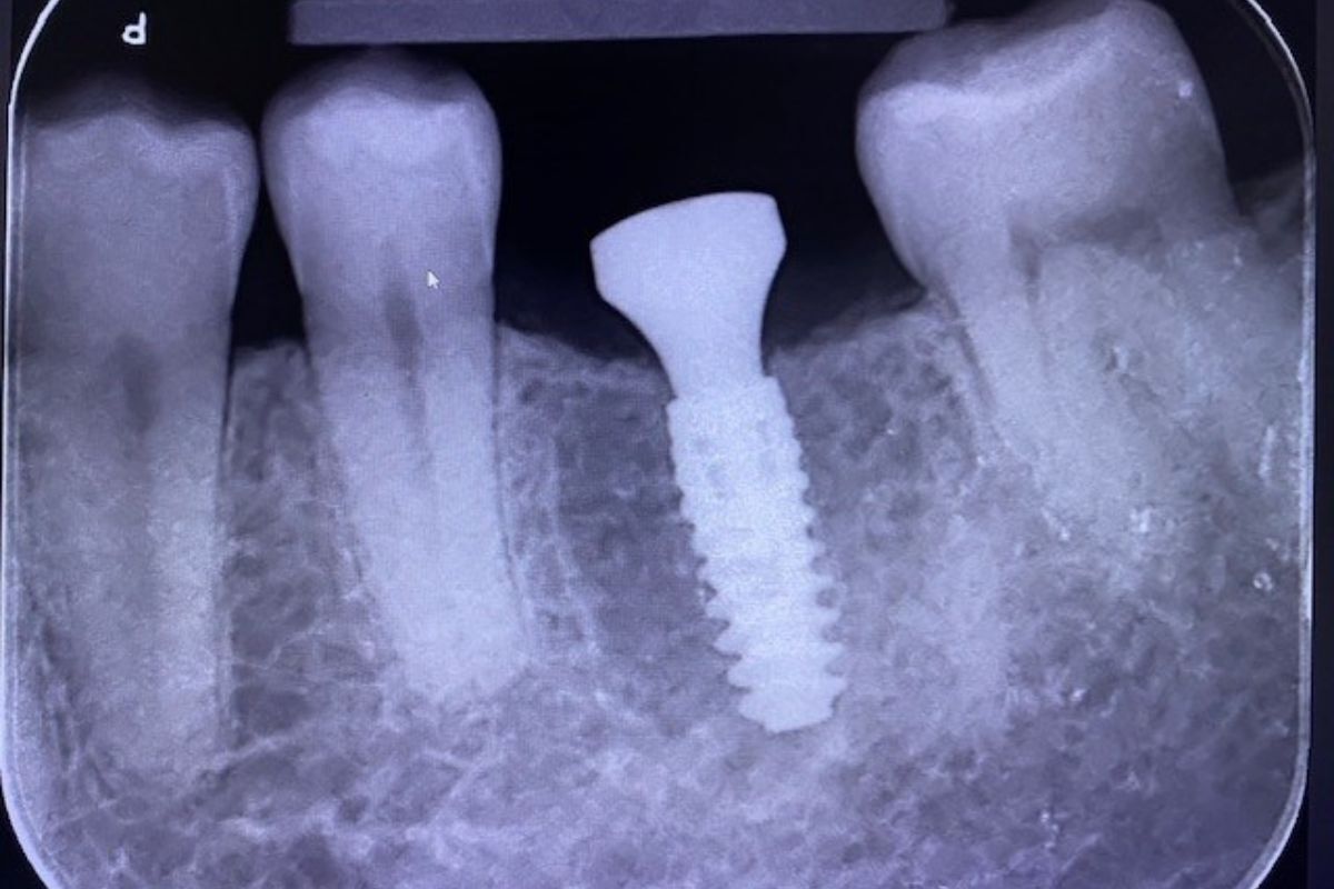 Dental Implant Safety Xray