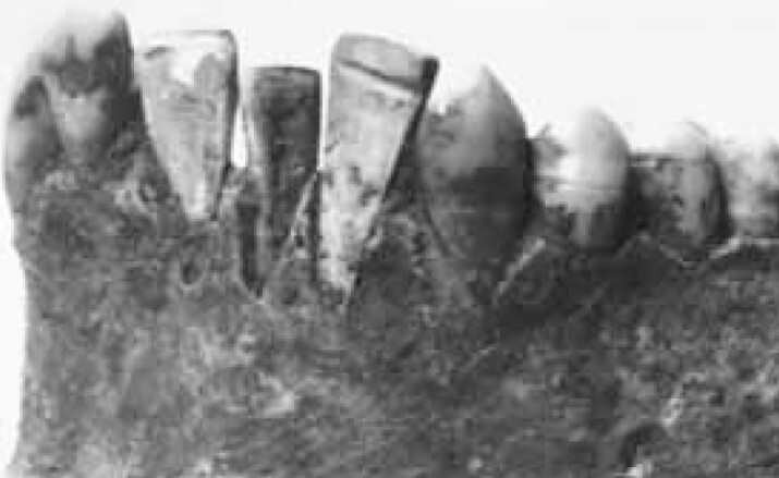 Mayan dental implants