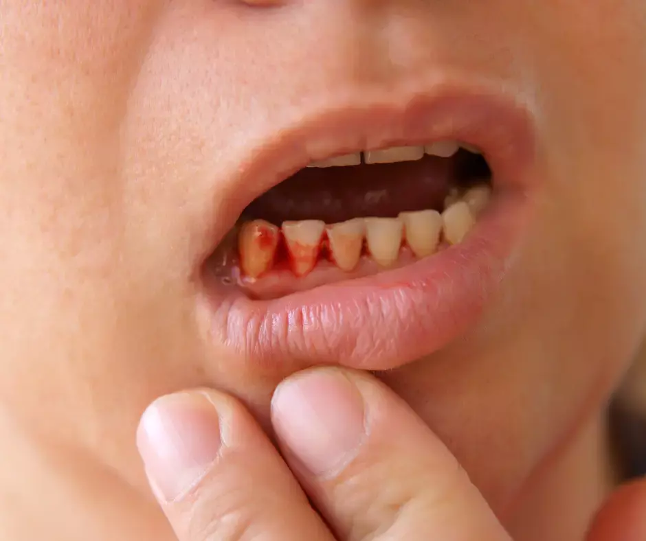 Bleeding and swollen gums are a sign of gum disease