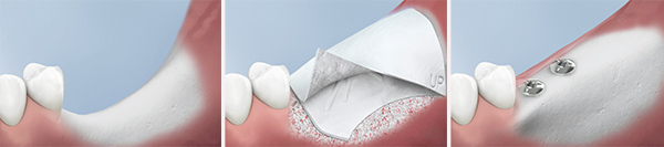 Dental Implants at Audley Dental Soltutions