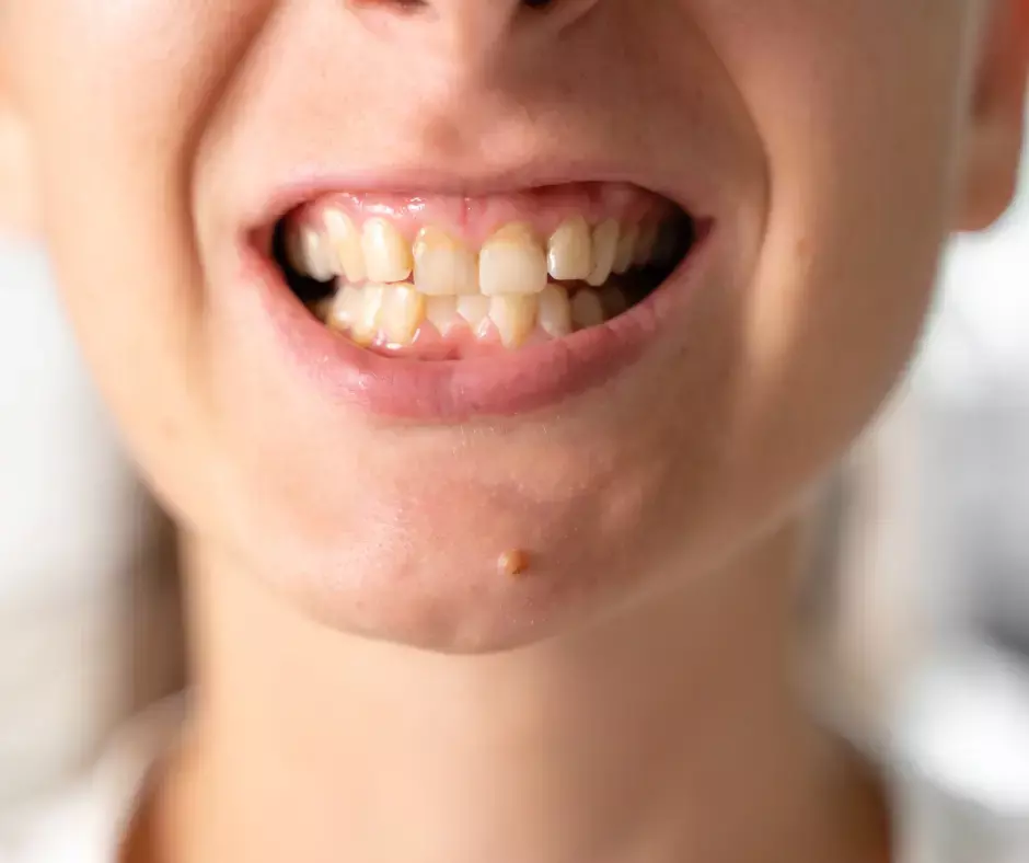 Woman with loose and wobbly teeth