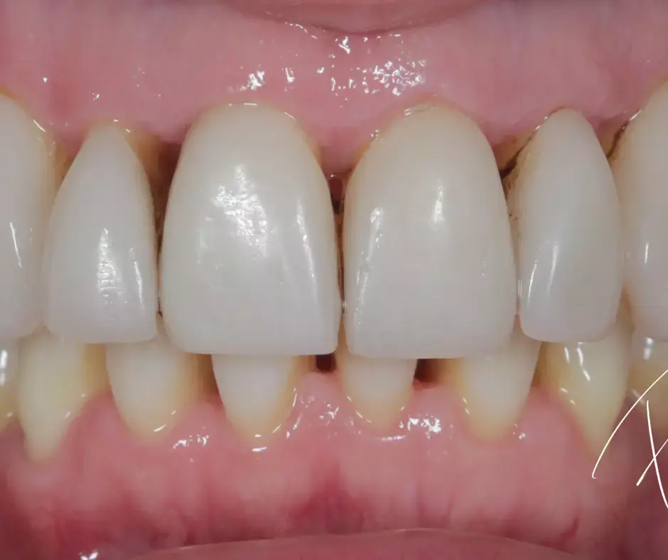 Gums that are receded due to periodontal disease (gum disease)